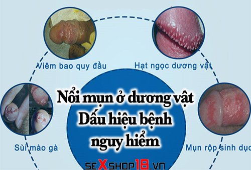 Nốt ruồi ở cậu nhỏ có ý nghĩa gì trong y học?