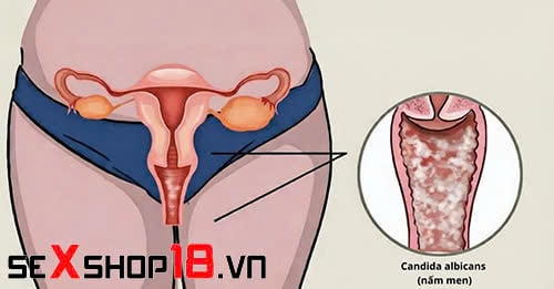 Quan hệ ngày đèn đỏ có bị vô sinh không? Sự thật khoa học 4 quan hệ ngày đèn đỏ có bị vô sinh không? nguy cơ viêm nhiễm
