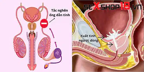 Cực khoái khô là gì? Nguyên nhân, dấu hiệu và cách chữa trị 3 Nguyên nhân gây cực khoái khô là gì