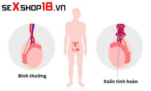 Xoắn tinh hoàn có tự khỏi không? Dấu hiệu và cách điều trị 1 Đàn ông bị xoắn tinh hoàn có tự khỏi