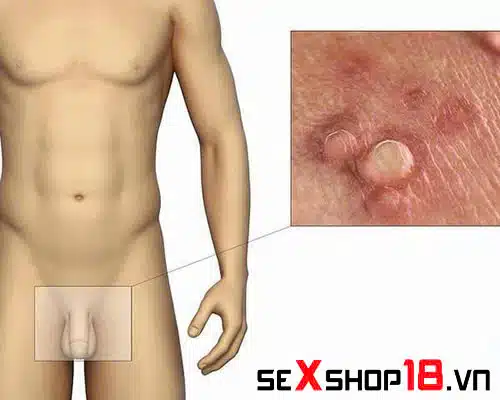 Đeo bao cao su có bị sùi mào gà không - Giải đáp từ bác sĩ 2 Đeo Bao cao su có bị sùi mào gà không? Dấu hiệu nhận biết
