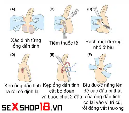Thắt ống dẫn tinh có quan hệ được không? Giải đáp từ A – Z 2 Đàn ông thắt ống dẫn tinh có quan hệ được không?