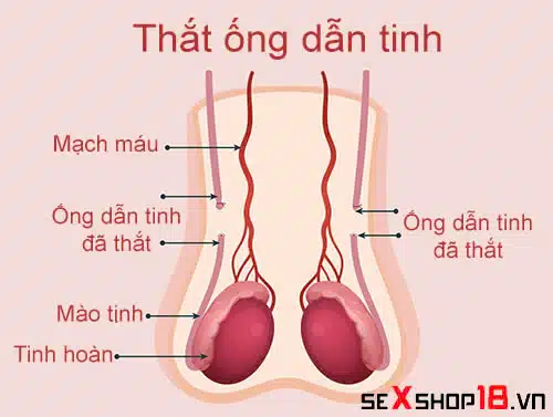 Thắt ống dẫn tinh có quan hệ được không? Giải đáp từ A – Z 3 Thắt ống dẫn tinh có quan hệ được không? Có đau không?