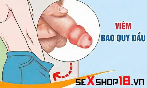 Viêm bao quy đầu có quan hệ được không? Giải đáp y khoa 1 Viêm bao quy đầu có quan hệ được không? nguy cơ viêm nhiễm