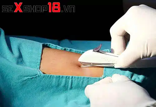 Cấy que tránh thai bao lâu thì có tác dụng? Giải đáp y khoa 5 Cấy que tránh thai bao lâu thì có tác dụng nếu cấy đúng thời điểm vàng