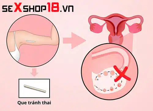 Cấy que tránh thai bao lâu thì có tác dụng? Giải đáp y khoa 1 Cấy que tránh thai bao lâu thì có tác dụng và cơ chế tác động ra sao?