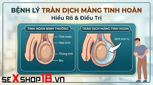 Tràn dịch màng tinh hoàn bao lâu thì khỏi? Bác sĩ giải đáp 1 Trẻ sơ sinh bị tràn dịch màng tinh hoàn bao lâu thì khỏi?